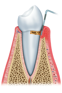 Initial Periodontitis