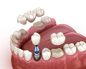 Dental Implant VS Crown and Bridge