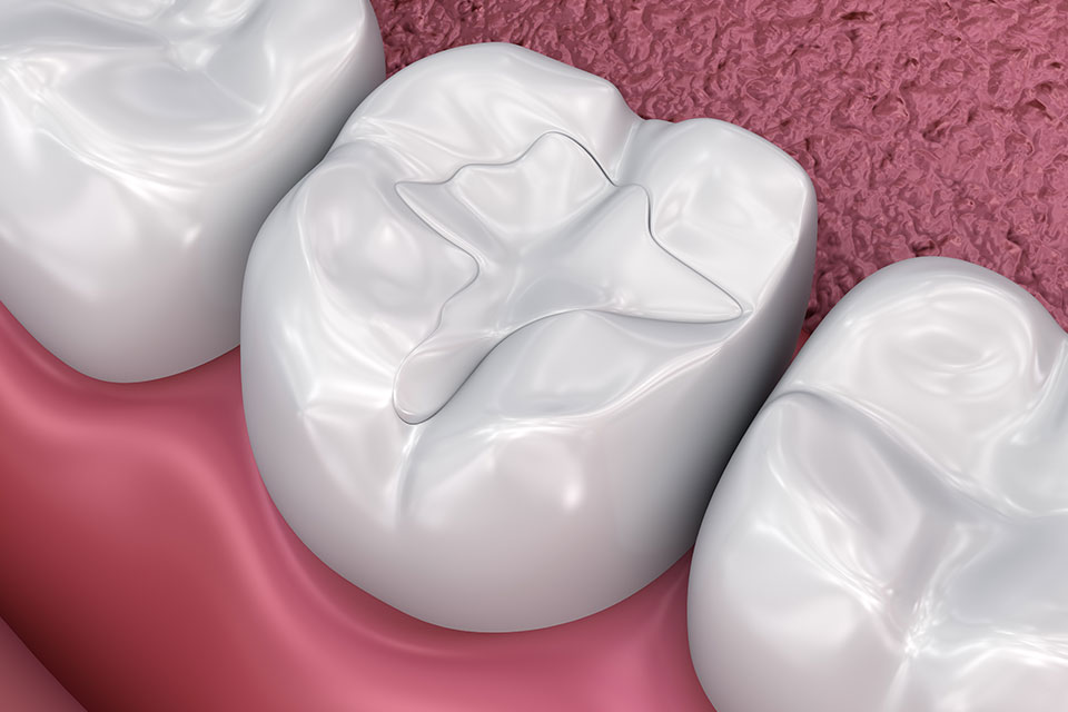 Tooth Colored Fillings