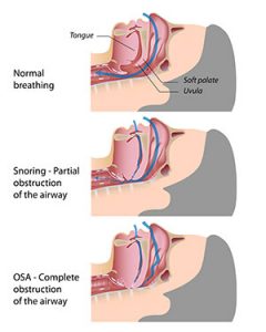 Sleep Apnea Diagram