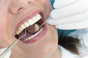 Periodontal Maintenance Checkup