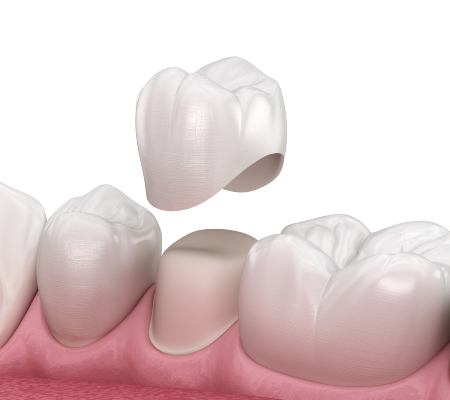Placement of Pre-Molar Dental Crown