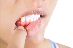 Gums Hurt Periodontal Disease