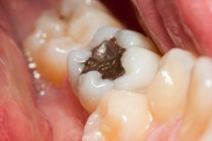 Old Fillings Using Amalgam