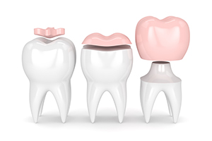 Inlays and Onlays VS Crowns