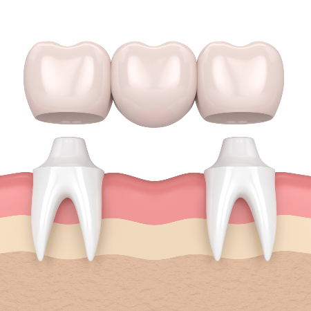 Dental Bridge Illustration